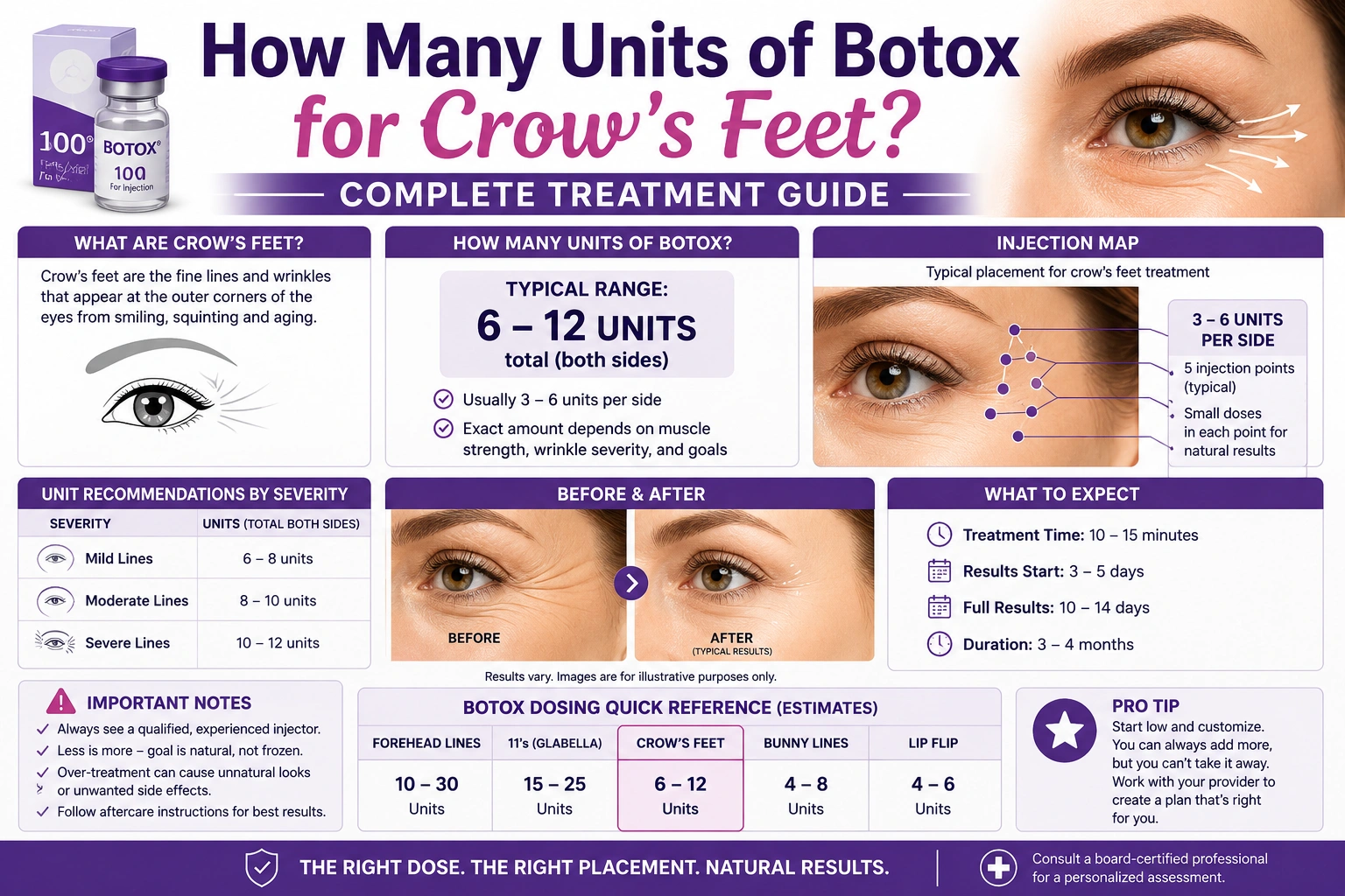 how many units of botox for crow's feet
